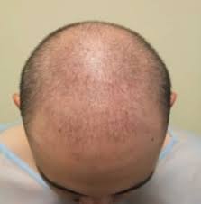Side effects requiring immediate medical attention. Latanoprost As An Experimental Hair Restoration Treatment
