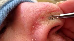 Di pasaran sebenarnya tersedia banyak krim atau obat yang dapat dimanfaatkan untuk membantu mencerahkan dan kunyit juga berkhasiat sebagai zat antiperadangan. Cara Menghilangkan Komedo Yang Membandel Di Hidung Hingga Pipi Baik Yang Hitam Maupun Putih