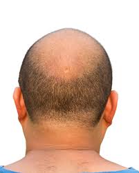 The connection between hair loss and magnesium.how to know and beat magnesium deficiency. Magnesium Oil For Hair Loss Does It Help Hairguard