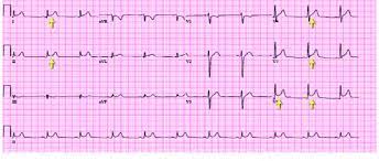It is not rare to find that patients admitted to an intensive care unit with chest pain, localised ischaemic ecg abnormalities or pathological q waves, segmental left ventricular dysfunction on echocardiographic or cineangiographic evaluation, and mild elevation of creatine kinase have normal coronary arteries. Shows The Ecg Scan Of Myocarditis And Pericarditis Download Scientific Diagram