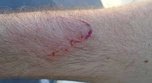 If all you have at hand is some duct tape and a disposable camera, fear not, you have the makings of a powerful taser! Temecula Doc Opens Up About Deputy S Wound Following Fallbrook Taser Incident San Diego Reader