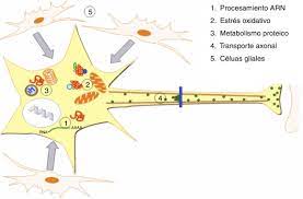 La esclerosis lateral amiotrofica es tan frecuente como la esclerosis multiple y mas que la distrofia muscular. Por Que Degeneran Las Motoneuronas Actualizacion En La Patogenia De La Esclerosis Lateral Amiotrofica Sciencedirect