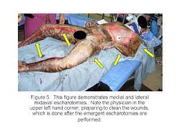Avoid incisions along flexural creases of joints. 5 Escharotomy Wheeless Textbook Of Orthopaedics