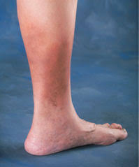 Image result for liver spots on legs