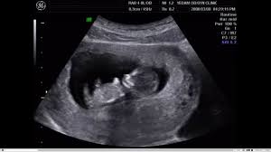 La trisomie 21, c'est la vie. Pranataldiagnostik 10 Regeln Fur Die Erfolgreiche Anwendung Von Nipt