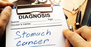 There are many possible symptoms of stomach cancer, but they might be hard to spot. Women With Stomach Cancer Live Longer Than Men Patients Women Manorama English