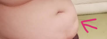 Plotzliche Kleine Delle Im Bauch Medizin