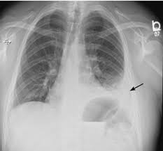 Pleural eﬀusions can loculate as a result of adhesions. Rapidly Progressive Pleural Effusion Cleveland Clinic Journal Of Medicine