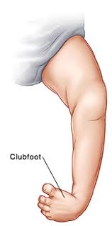 Club foot synonyms, club foot pronunciation, club foot translation, english dictionary definition of club foot. When Your Child Has Clubfoot