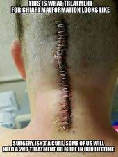 That S What I Looked Like After My Chiari Malformation Type 1 I Asked My Daughter To Go Behind Me And Chiari Malformation Surgery Chiari Malformation Chiari