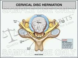Pin By Stock Trial Exhibits On Stock Medical Exhibits Cervical Disc Disk Herniation Medical Illustration