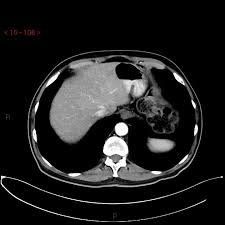 Early breast cancer is stage i or ii. Male Breast Cancer Radiology Case Radiopaedia Org