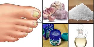 Hongos En Las Uñas De Las Manos Como Eliminarlos 5 Remedios Caseros Para Eliminar Los Hongos En Las Unas Hongos En Las Unas Infeccion Por Hongos Eliminar Hongos