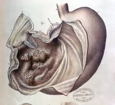 At the end of life, the chemical balance of the body becomes completely upset. Gastric Cancer Physiopedia