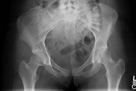 Female muscle growth myth #1: A 24 Year Old Woman With Right Groin Pain