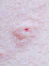 Bug Bites That Look Like Mosquito Bites But Aren T Common Spiders And Spider Bites All Spiders Have Venom But Only A Few Spider Bites Are Harmful To Humans Spider Bites Spider Bite Treatment