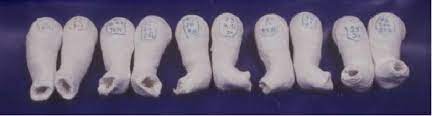 Ponseti casting is a technique used to correct a clubfoot gently and gradually. Casting For Club Foot Wheeless Textbook Of Orthopaedics