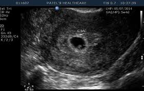 An ultrasound can help confirm or rule out an this condition. 6 Week Ultrasound Surrogacy Journey To India And Back