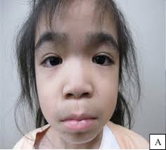 About 60% of individuals with down syndrome (also known as trisomy 21) have. Case Report Of Chromosome 3q25 Deletion Syndrome Or Mucopolysaccharidosis Iiib Springerlink