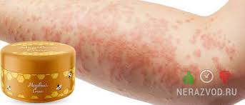 Check spelling or type a new query. Krem Medovyj Spas Ot Dermatita Otzyvy Gde Kupit Instrukciya