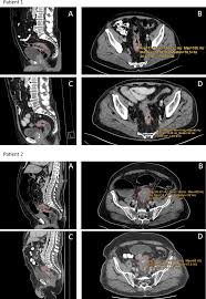 Computertomography-Based Prediction of Complete Response Following  Neoadjuvant Chemoradiotherapy of Locally Advanced Rectal Cancer - Frontiers