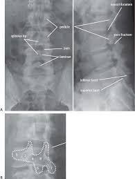 Anterior vertebral line, posterior vertebral line, spinolaminar line, posterior spinous line. 1 Spinal Anatomy And Approaches Neupsy Key