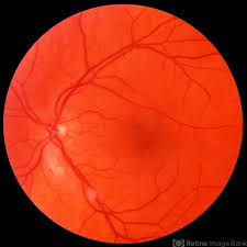 Image result for HIV Retinitis