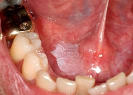 Image result for white cancer on tongue)