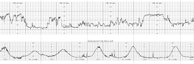 Image result for Late Deceleration