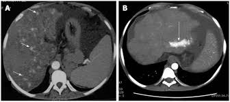 Imaging And Interventions In Budd Chiari Syndrome