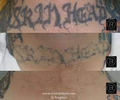 Watercolor, old school, new school, chinese/japanese style, portrait, black&grey, etc. Tattoo Removal Clinics