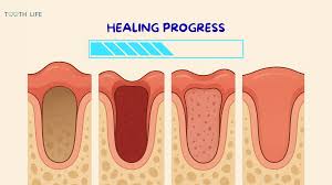 Image result for Tooth Extraction