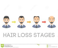 Information Chart Of Hair Loss Stages Types Of Baldness