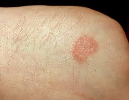 Dermatomykose Wikipedia