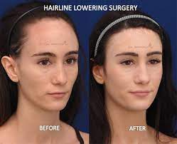 Forehead Reduction Surgery Hairline Lowering Surgery Before And After Photos Forehead Reduction Forehead Reduction Surgery Haircut For Big Forehead