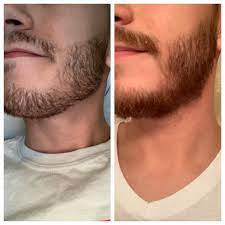 Patchy Beard Will The Patch Go Away 18 Days Vs 40 Days Patchy Beard Patchy Beard Styles Thin Beard