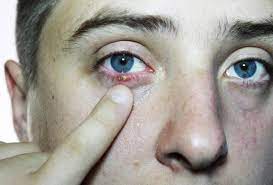 9 Causas De Venas Rojas En Los Ojos Y Como Quitarlas