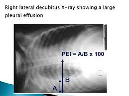 It is commonly referred to as fluid around the lungs or water surrounding the this is maintained by the hydrostatic pressure from the pleura and blood vessels, and the osmotic pressure within the pleural space. Pleural Effusion Pleural Effusion Pleural Cavity And Space Visceral Pleurae Envelop All Surfaces Of The Lungs Including The Interlobar Fissures Ppt Download