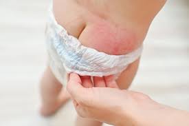 Image result for diaper dermatitis