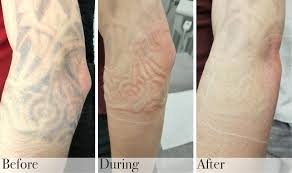 The average cost of laser tattoo removal is $423, according to 2020 statistics from the american society of plastic surgeons. Tattoo Removal Drbk Award Winning Clinic In Reading Berkshire
