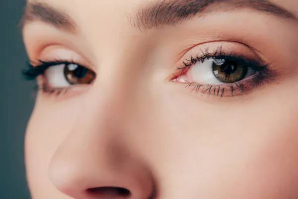 Xanthelasma Removal - Perfect Eyes Ltd