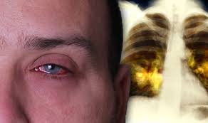 A cancer may also cause symptoms like fever, extreme tiredness (fatigue), or weight loss. Lung Cancer Symptoms Signs Of A Tumour On Your Face Include Having A Drooping Eye Express Co Uk