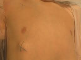 Lumps can appear anywhere within the breast. Soft Tissue Masses Uw Orthopaedics And Sports Medicine Seattle
