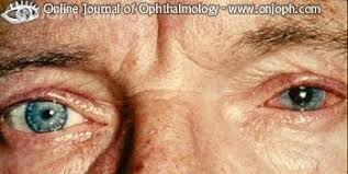 When this drainage pathway is narrowed or closed, inadequate drainage of. Atlas Of Ophthalmology