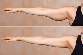 Women often complain about fat arms. How To Get Rid Of Upper Arm Fat 10 Killer Exercises