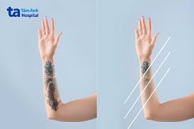 Xóa xăm laser có thật sự hiệu quả? Ưu và khuyết điểm ra sao?