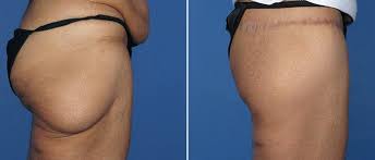 Thigh Lift Surgery