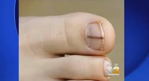 There's also a change in their size, color, and shape. Here S Why You Should See A Doctor If You Notice Black On Your Nail