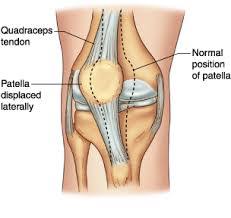 If this is your first visit, be sure to check out the faq & read the forum rules. Patellar Dislocation