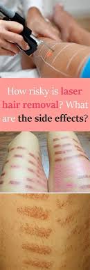 Immediately after treatment the skin on your face may be quite red. Laser For Hair Removal Side Effects Juvederm In 2021 Laser Hair Removal Laser Hair Hair Removal